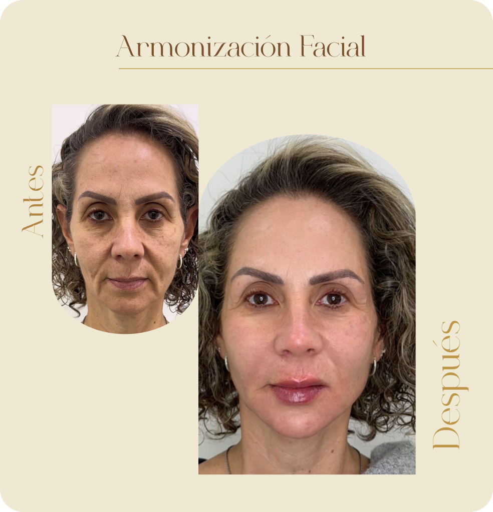 ImgAmortizacionFacial01