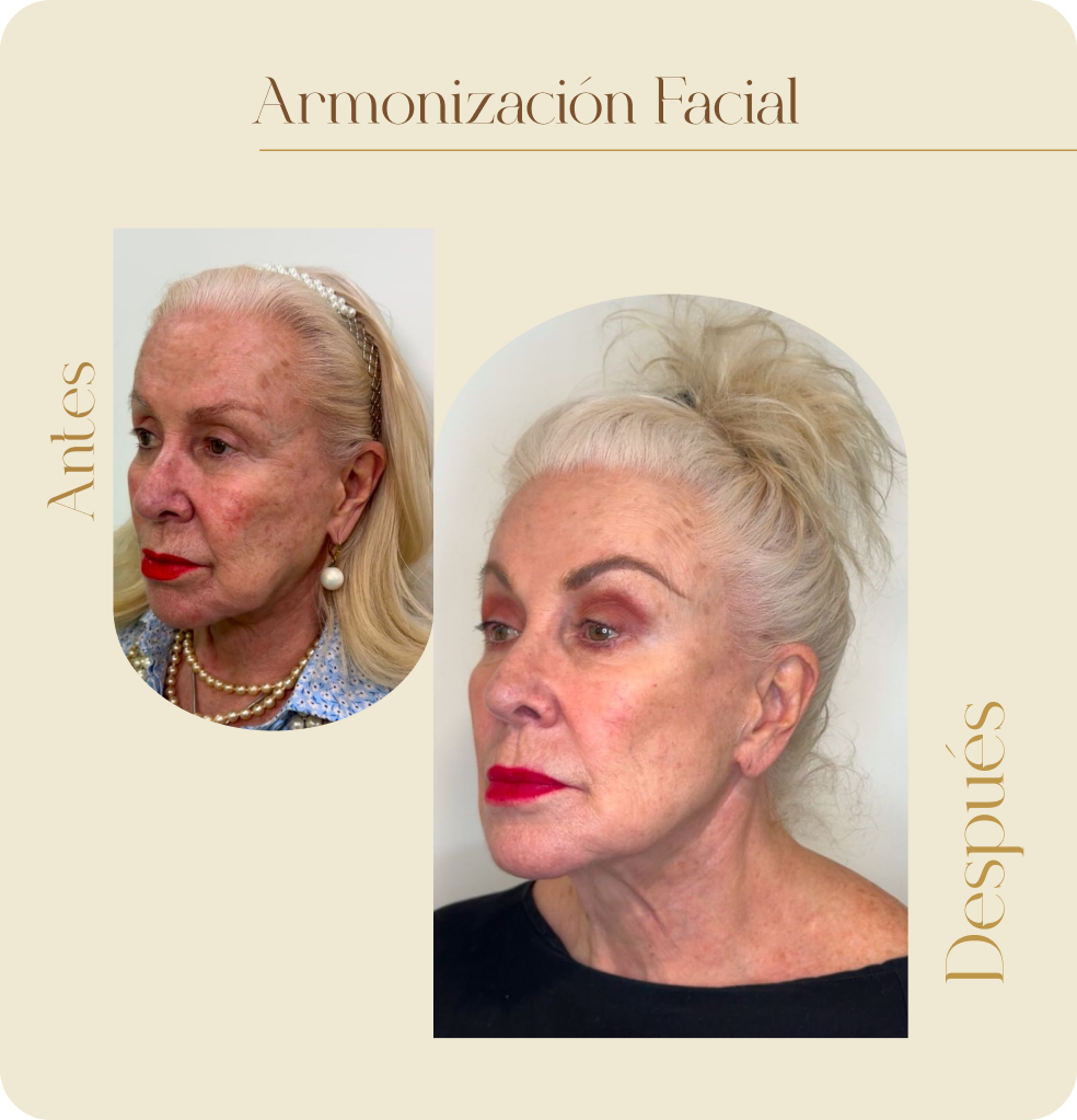 ImgAmortizacionFacial02