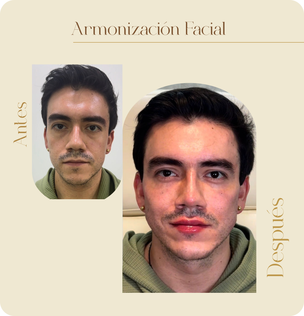 ImgAmortizacionFacial03