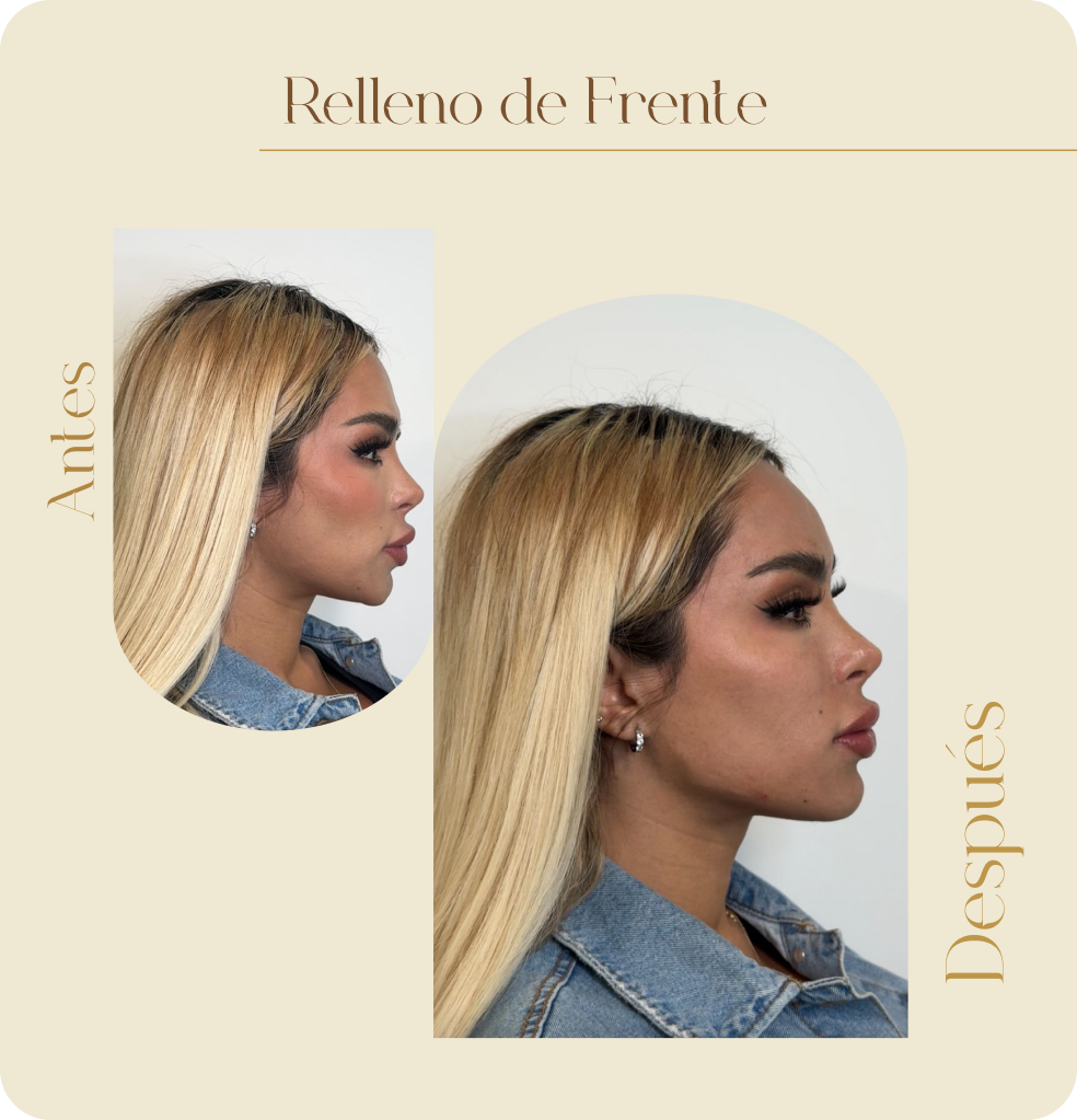 ImgAmortizacionFacial04