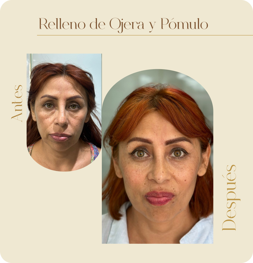 ImgAmortizacionFacial05