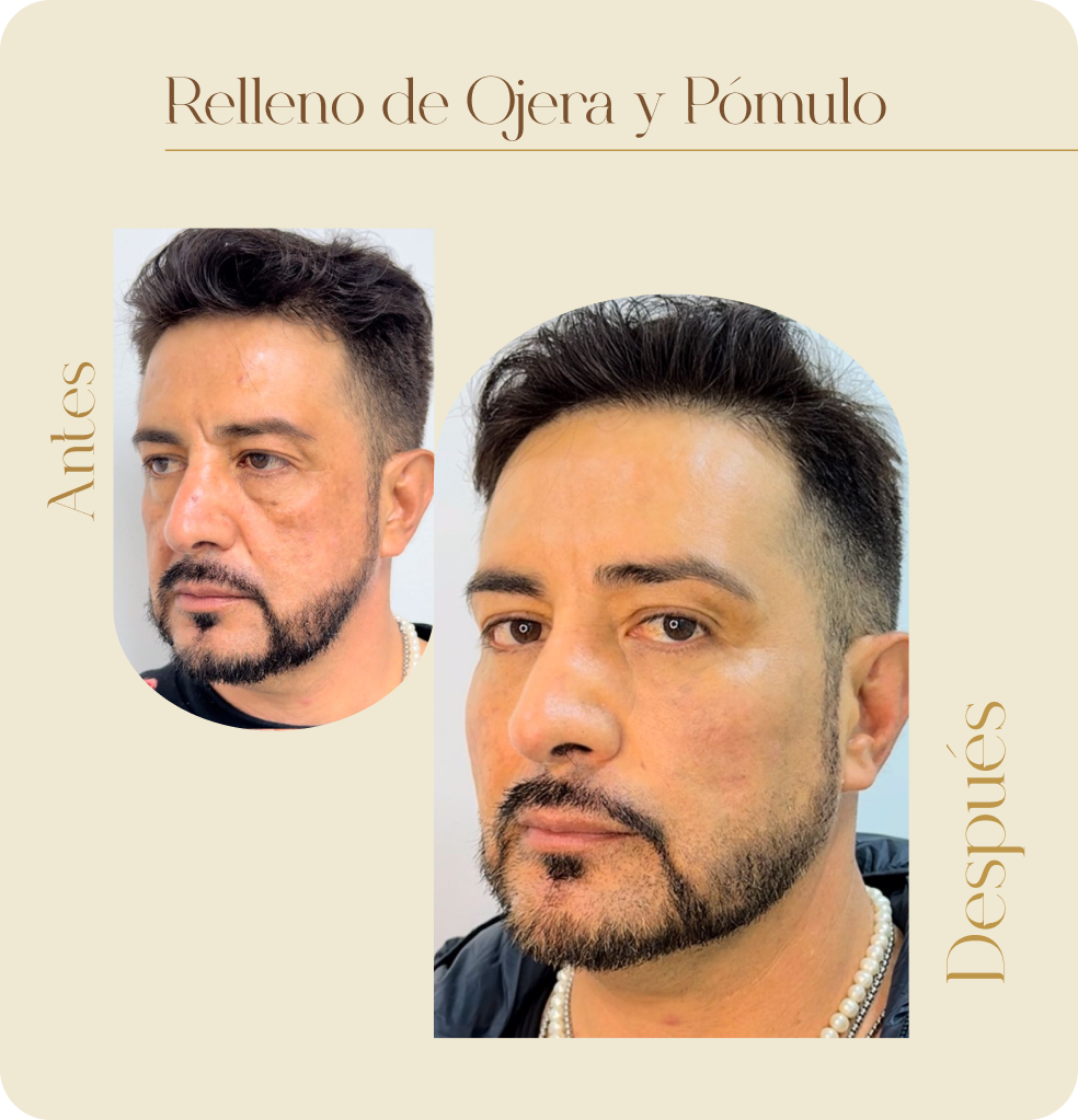 ImgAmortizacionFacial06