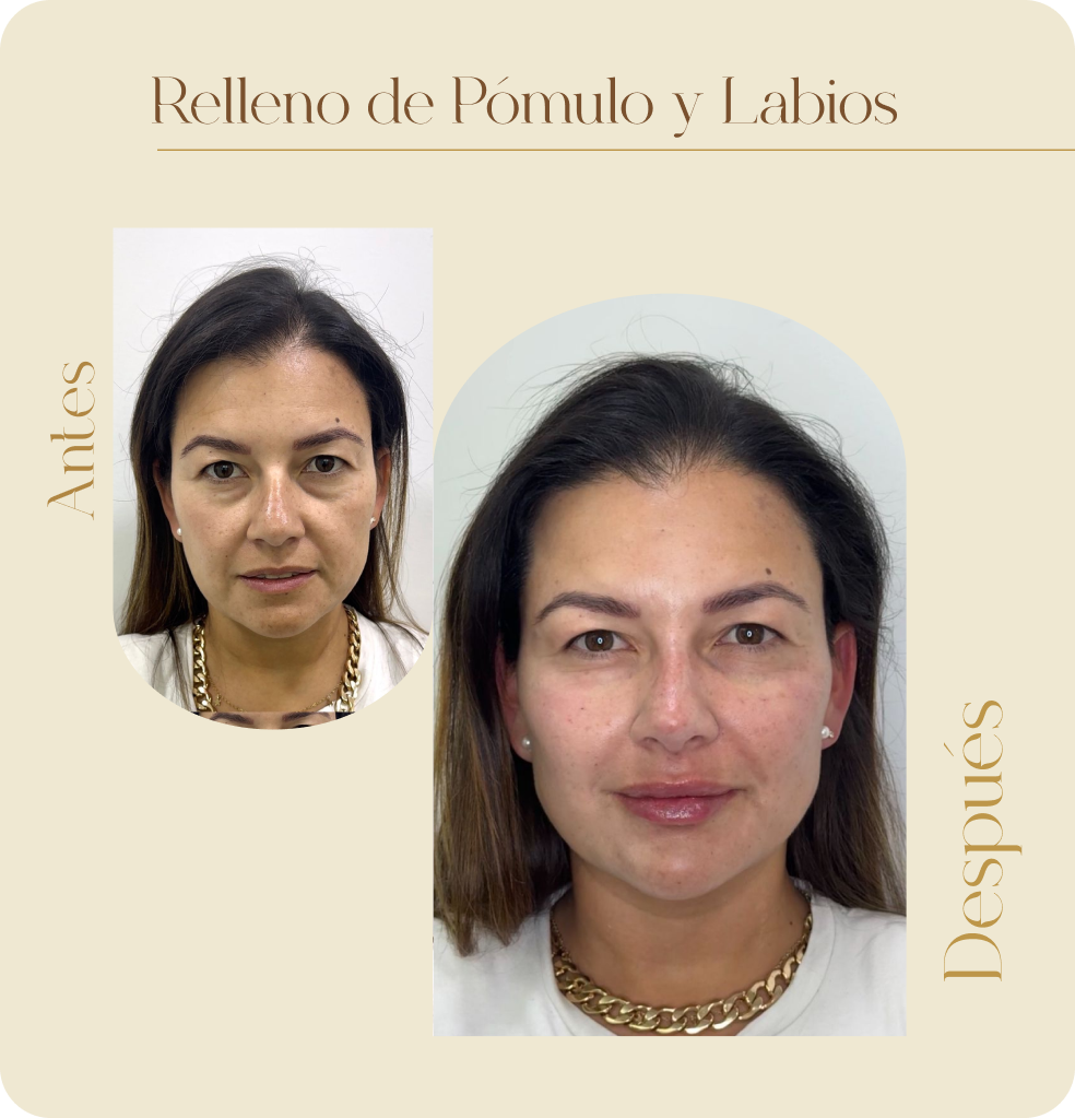 ImgAmortizacionFacial08