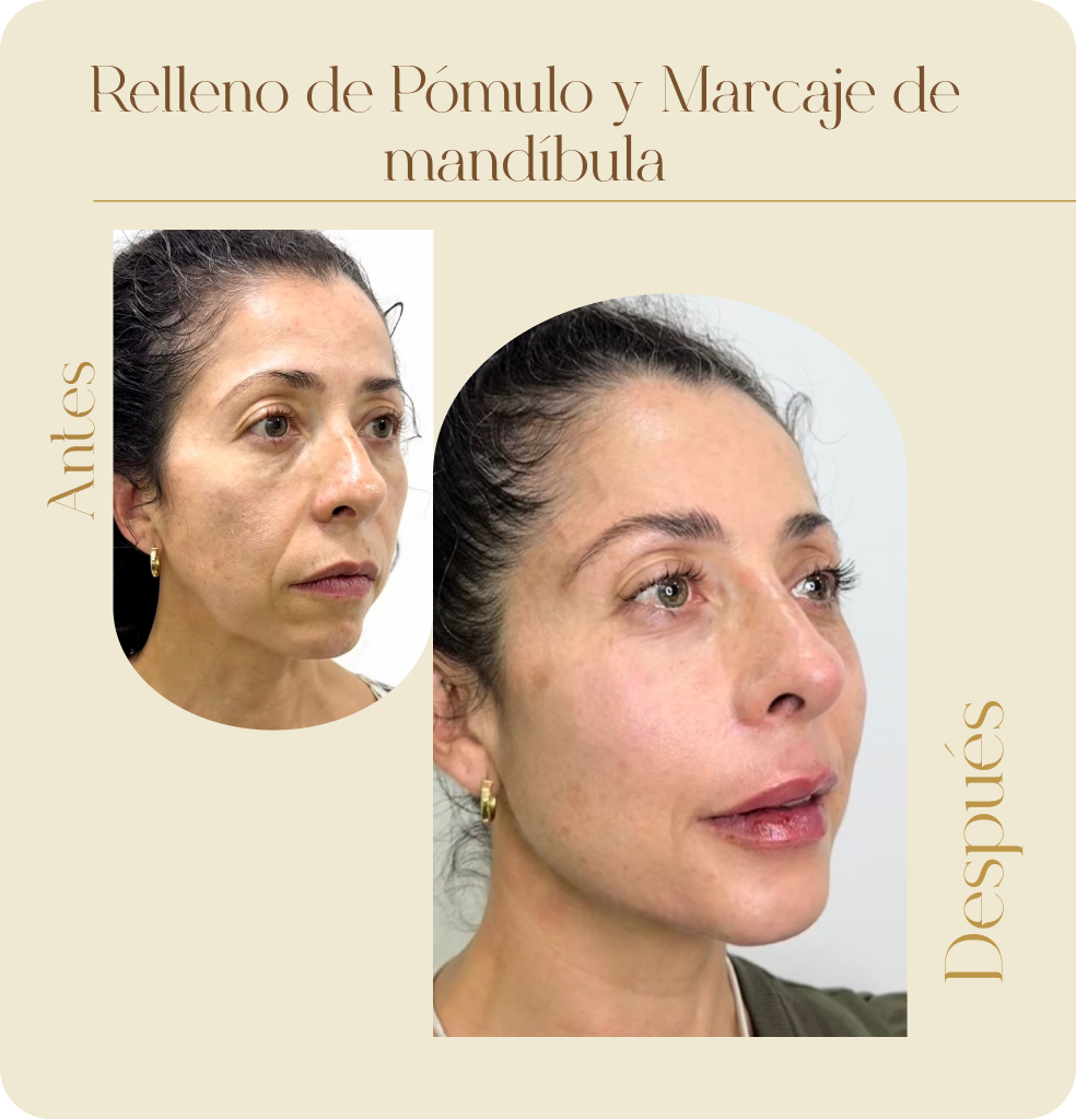 ImgAmortizacionFacial09