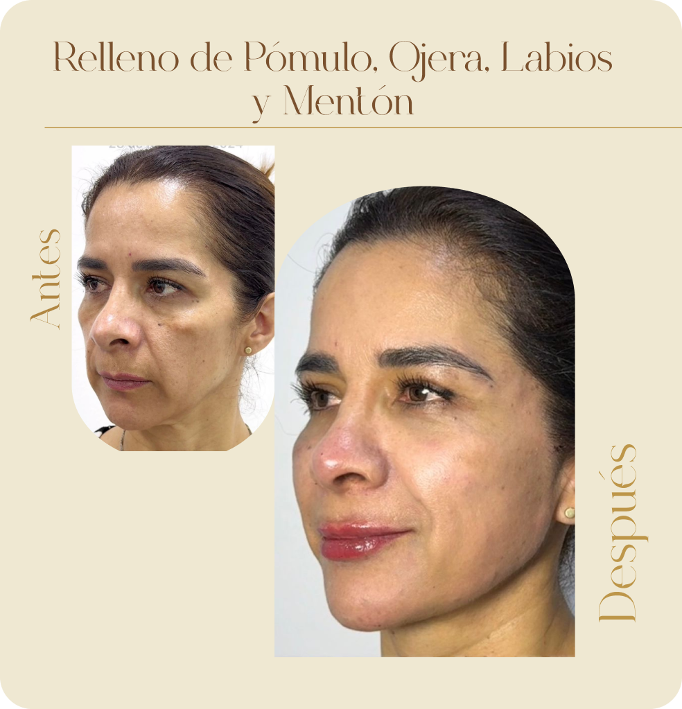 ImgAmortizacionFacial10