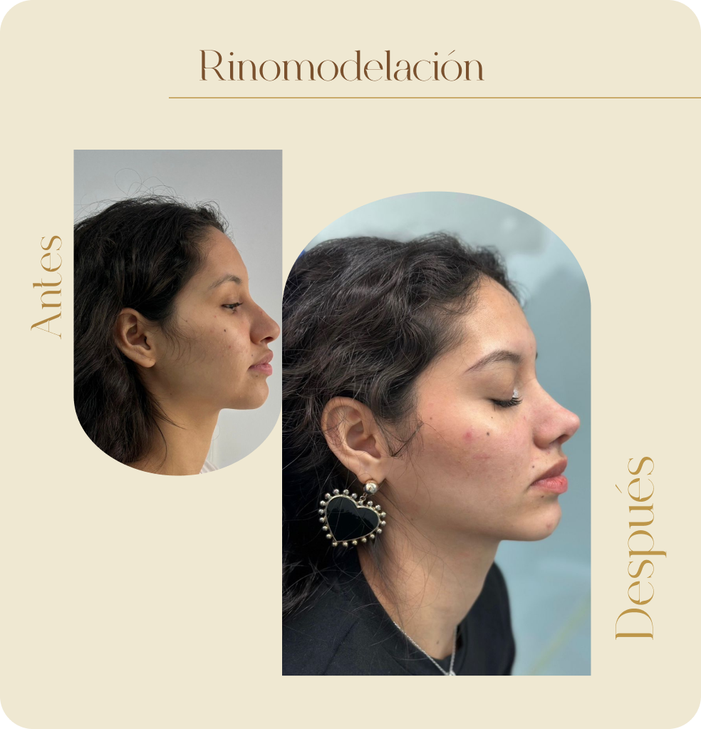 ImgAmortizacionFacial11