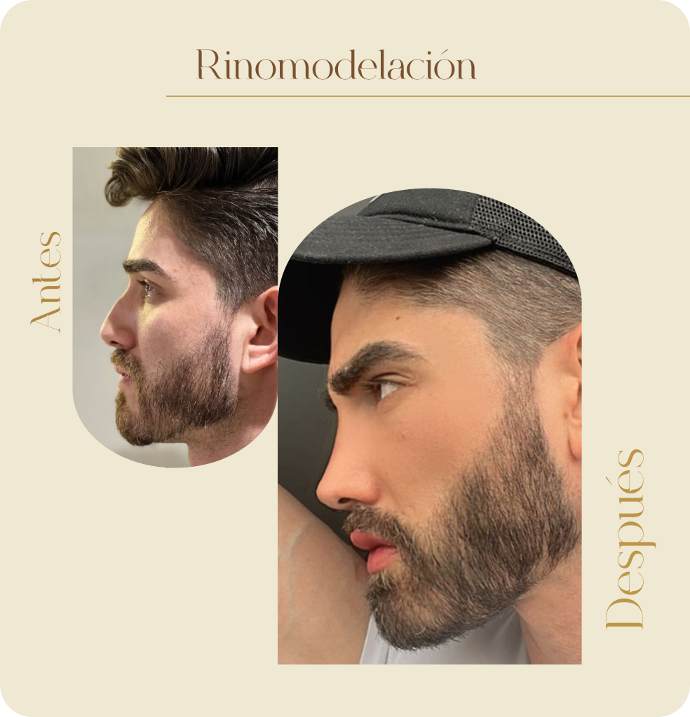 ImgAmortizacionFacial12