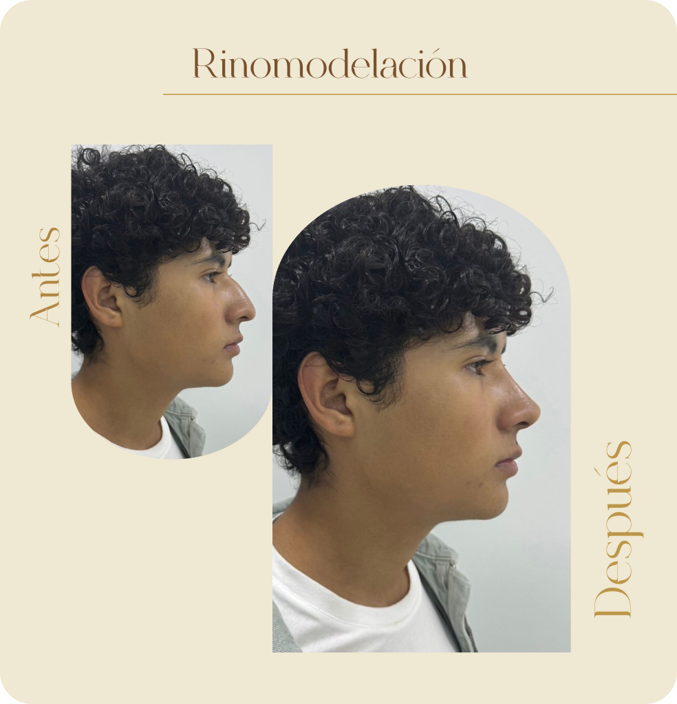 ImgAmortizacionFacial13